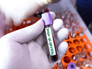 Blood sample for Dengue IgG, IgM and NS1Ag test at medical laboratory