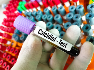 Blood sample for Calcidiol blood test, also known as the 25-OH vitamin D test.
