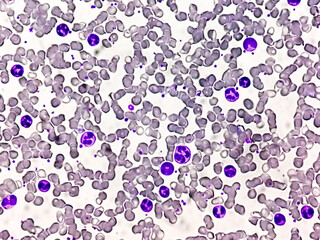 Chronic myelogenous leukemia (CML), also known as chronic myeloid leukemia, is a cancer of the white blood cells. chronic granulocytic leukemia 