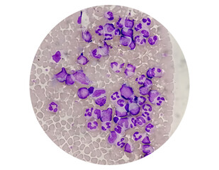 Chronic myelogenous leukemia (CML), also known as chronic myeloid leukemia, is a cancer of the white blood cells. chronic granulocytic leukemia 