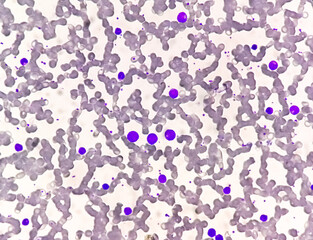 Chronic myelogenous leukemia (CML), also known as chronic myeloid leukemia, is a cancer of the white blood cells. chronic granulocytic leukemia 