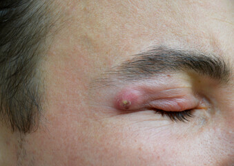 boil - a strong purulent abscess in a man near the eye. swelling from the infection has spread to the upper eyelid