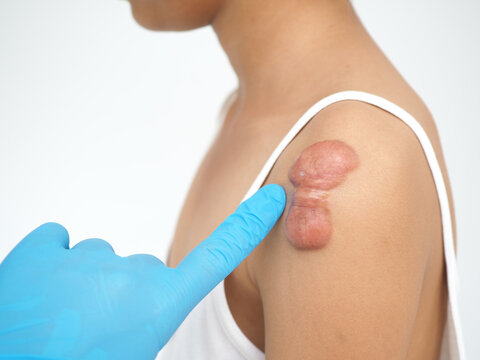 Keloid scar of skin shoulder kid girl case of tissue forms over the wound to repair treatment of laser to reduce size. closeup photo, blurred.