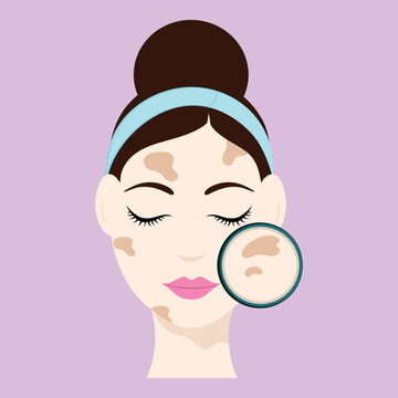 Smart Girl With Melasma On Face Icon On Pink Background.