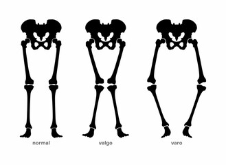 Normal and deformed leg bones position