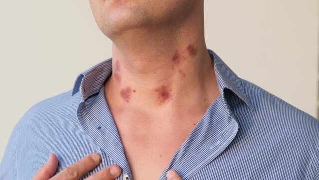 A man shows hickeys on his neck from kisses, close-up. Concept: passion, betrayal