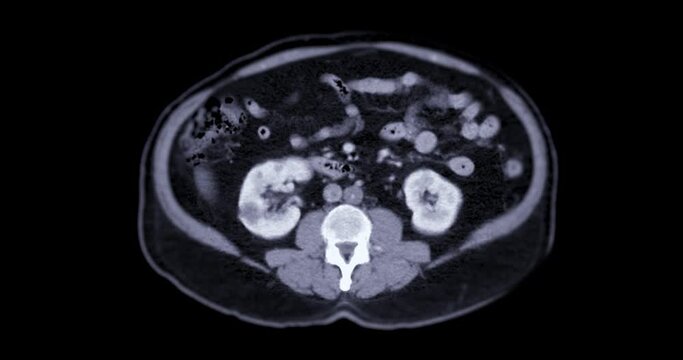 CT SCAN of Chest and Abdomen with injection contrast media for diagnonsis chest and abdomen disease.