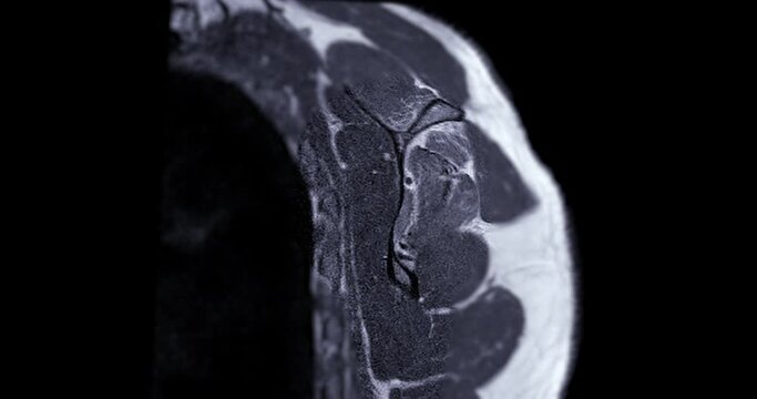 Magnetic resonance imaging (MRI) of Shoulder Joint for diagnostic shoulder pain.