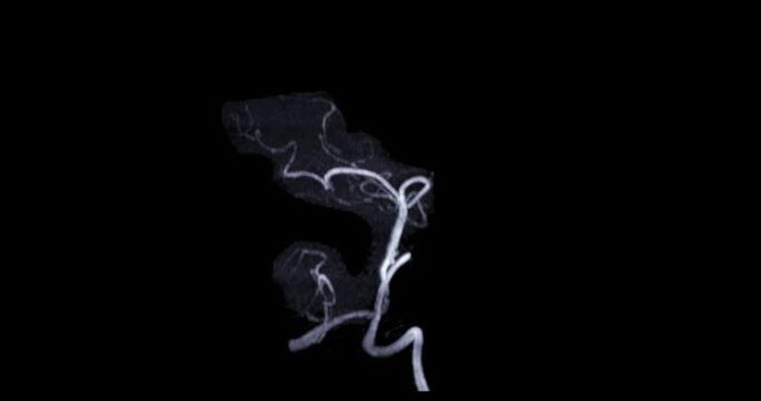 MRA Brain or Magnetic resonance angiography of Basila artery and carotid artery .