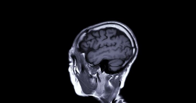 MRI of the brain in sagittal T1 showing anatomy of the brain.