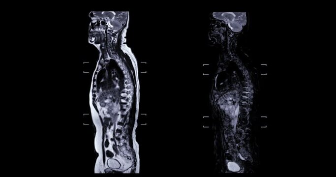 MRI Screening whole spine T2 and T2 FS   for diagnosis  spinal cord stenosis.