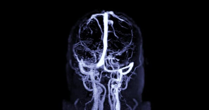 MR cerebral venography (MRV) is an MRI examination of the head with either contrast-enhanced or non-contrast sequences to assess patency of the dural venous sinuses and cerebral veins. 