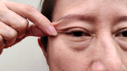 Portrait the fingers squeezing the flabbiness adipose sagging skin beside the eyelid, ptosis and...