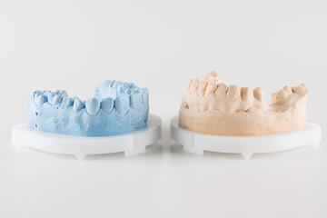 Obraz na płótnie Canvas dental crown made of ceramics
