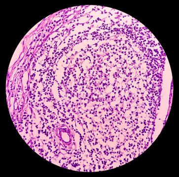 Photomicrograph of lymph node with Hodgkin's Disease (lymphoma), nodular sclerosis. showing polymorphous population of lymphocytes, histiocytes, mononuclear cells and eosinophils by fibrous bands.