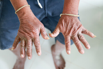 Skin disorder, pepper appearance from scleroderma, autoimmune disease male hand Skin disorder...