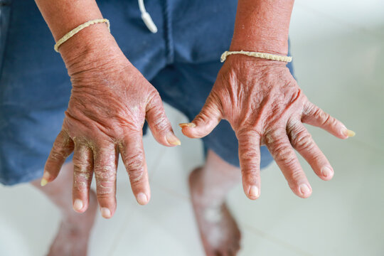Skin disorder, pepper appearance from scleroderma, autoimmune disease male hand Skin disorder pepper appearance from vitiligo,scleroderma raynaud, medical concept autoimmune disease. Skin disorder,