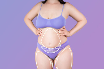 Abdomen and hips liposuction, fat and cellulite removal concept, overweight female body with...