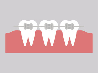 Metal braces dental orthodontic Teeth with braces. Alignment of bite of teeth, dental row with braces, Dental braces. Vector illustration	
