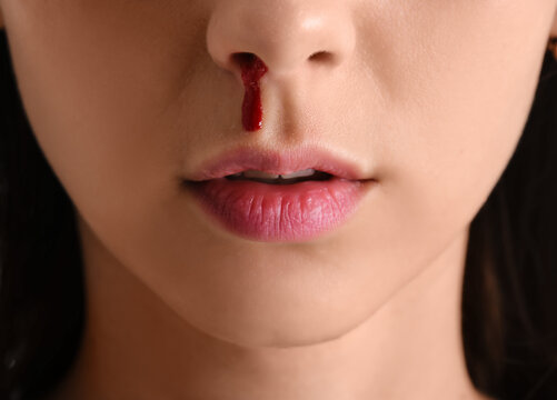 Young woman with nosebleed, closeup