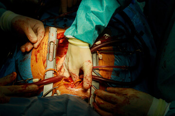 An operation room in hospital is where Coronary Artery Bypass Grafts CABG are performed as part of heart operations due to disease coronary heart disease