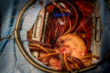Due to malfunctioning heart valve, open heart surgery is required for during the procedure valve...