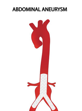 Endovascular abdominal aneurysm repair illustration