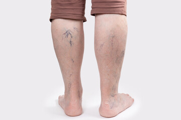 Varicosity. Close up view of old legs of woman with vascular asterisks. Back view. White background. The concept of varicose veins