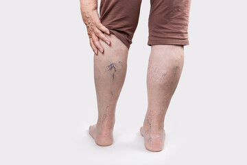 Varicosity and laser treatment. Close up of elderly legs of woman shows vascular asterisks. Rear...