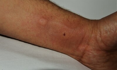 Fototapeta premium Two bee stings on the arm of a man. Stung by worker bees . skin allergy, allergic. treatment by honey bee sting. insects, insect, animal, wildlife, wild nature 