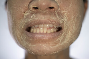 Image of a person whose teeth and gums are deformed and unattractive.