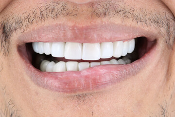 white perfect teeth man perfect smile