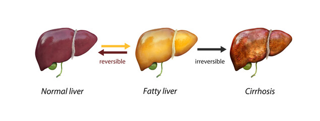 Normal liver versus liver with Cirrhosis, damaged liver, excessive drinking of alcohol, treatment, - obrazy, fototapety, plakaty