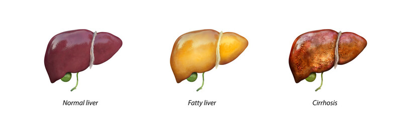 Normal liver versus liver with Cirrhosis, damaged liver, excessive drinking of alcohol, treatment,