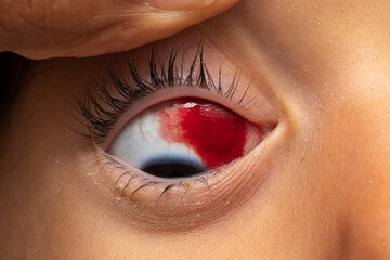 Subconjunctival hemorrhage, macro of blood in a child's eye due to ruptured capillaries