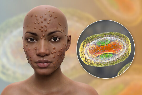 Patient with monkeypox and close-up view of monkeypox virus, 3D illustration
