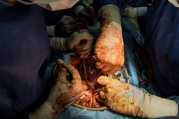 Coronary artery bypass graft CABG is performed for heart operations due to diseases such as...