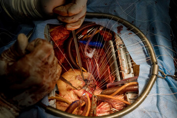 During open heart surgery malfunctioning heart valve has to be replaced in operating room, order to...