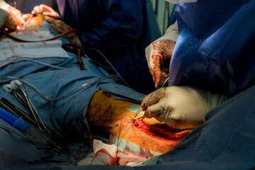 It is not uncommon for doctors in the operating room to sew up wound an injured leg