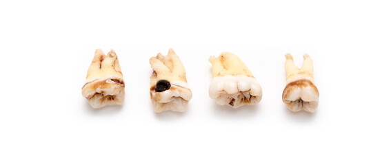 Set of teeth with caries on a white background. Wisdom teeth removed. Sick human teeth.