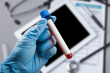 Blood sample tube for virus test. It is also known as the Moneypox virus,