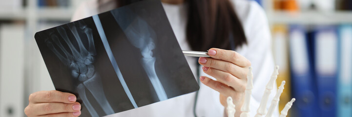 Doctor traumatologist examines x-ray with arm injury closeup