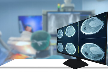 CT Scan brain Finding isodense mass with ill-defined margin and surrounding edema at the Left...