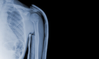 x-ray images of the shoulder joint under u-slab to see injuries bones fractures and tendons for a...