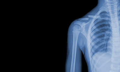 x-ray images of the shoulder joint to see injuries clavicle fracture and tendons for a medical...