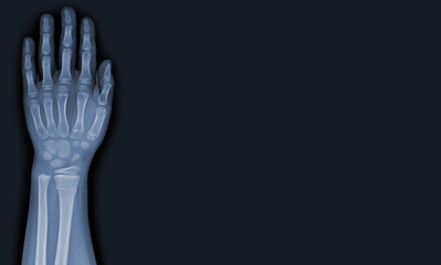 x-ray images of the hand and wrist joint to see injuries tendons and radius bone fracture for a medical diagnosis.Medical image concept and copy space.
