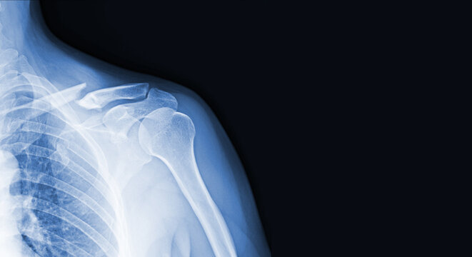 x-ray images of the shoulder joint to see injuries clavicle fracture and tendons for a medical diagnosis.Medical image concept and copy space.