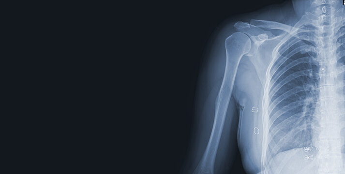 x-ray images of the shoulder joint to see injuries bones and tendons for a medical diagnosis.Medical image concept and copy space.