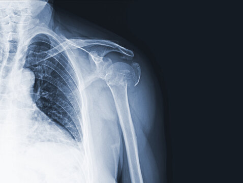 x-ray images of the shoulder joint to see injuries greater tubercle bones fracture and tendons for a medical diagnosis.Medical image concept and copy space.