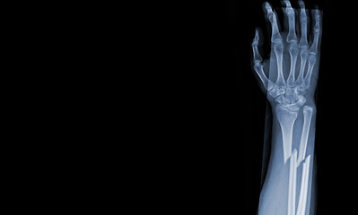 x-ray images of the both hand and wrist joint ap views to see injuries radius and ulna bond...